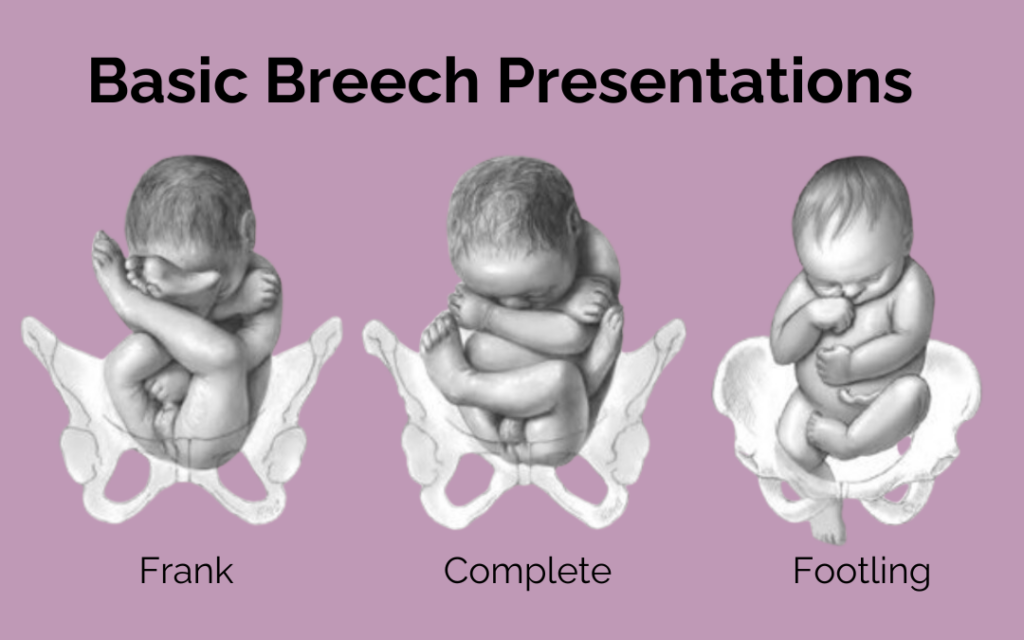 An image showing the types of breech birth: Frank, Complete, & Footling