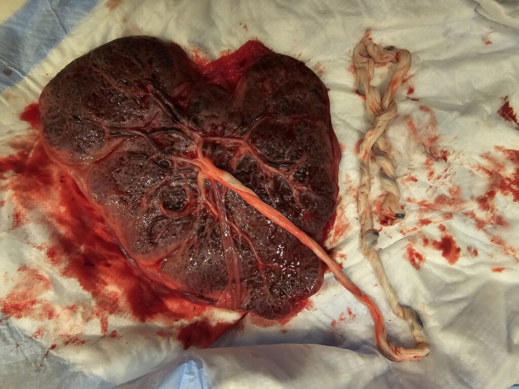 Heart-shaped placenta with umbilical cord showcasing its unique formation.