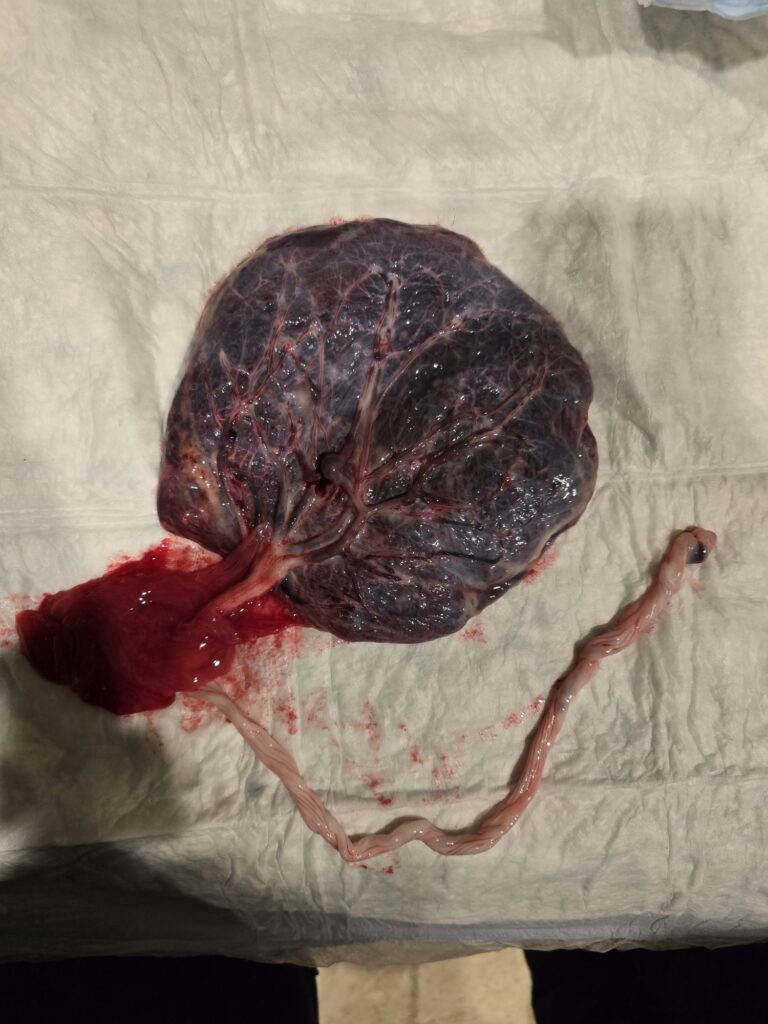 Human placenta with marginal or eccentric umbilical cord insertion showing visible blood vessels and cord structure.