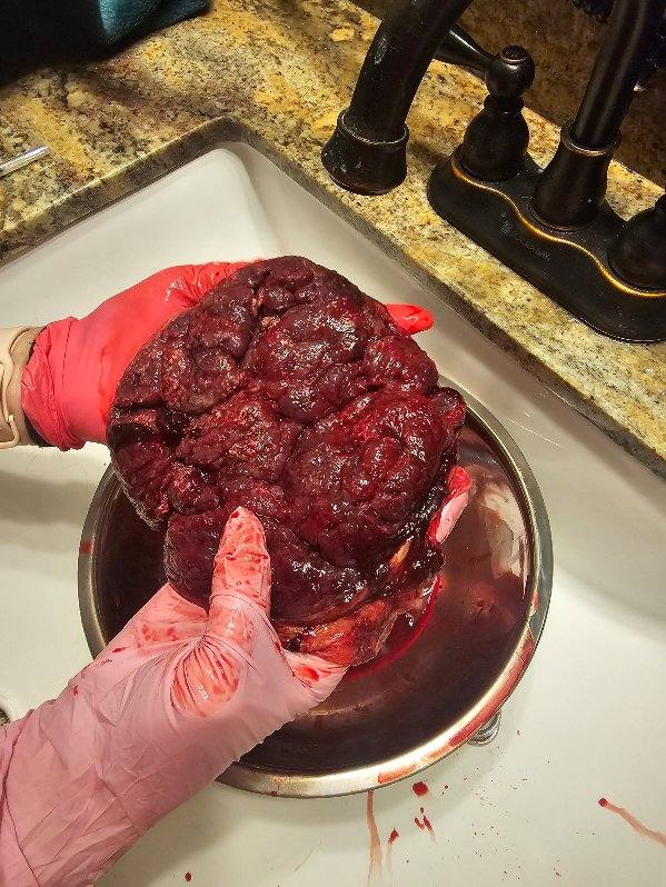 Close-up of a placenta viewed from the uterine attachment side, showcasing its texture and blood vessels.